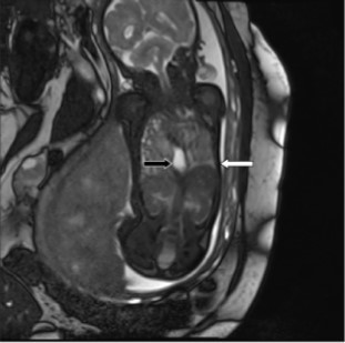 Congenital diaphragmatic hernia