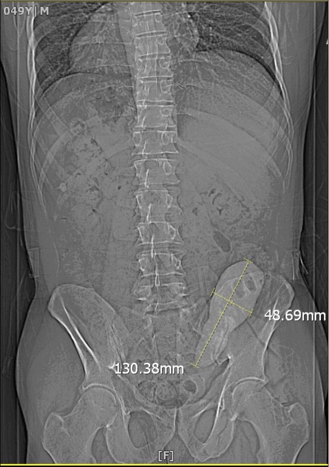 Journal of Medical and surgical Urology-ileal condiut