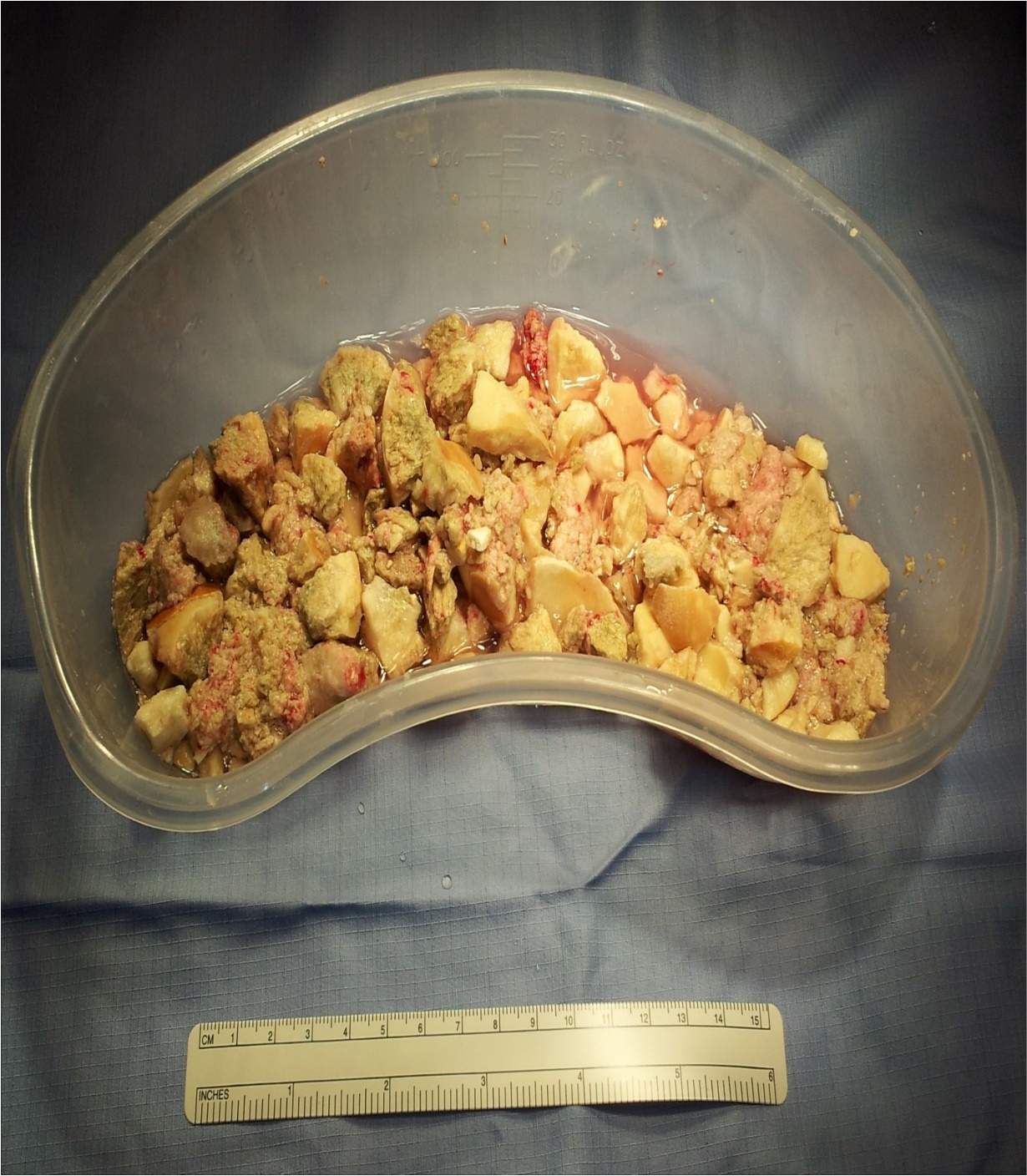 Journal of Medical and surgical Urology-ileal condiut