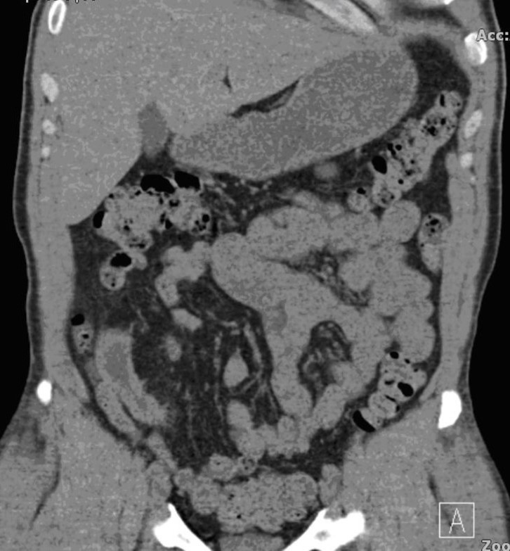 Journal of Medical and surgical Urology-ileal condiut