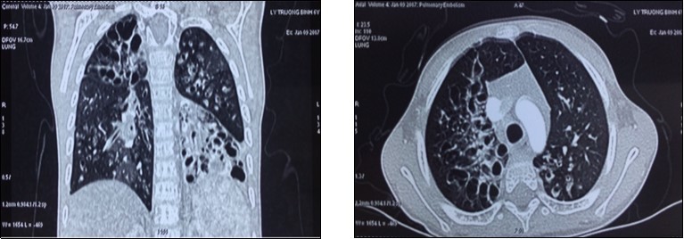 Lung transplantation