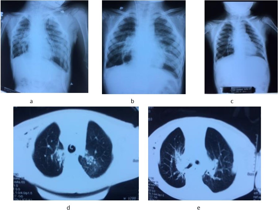 Lung transplantation