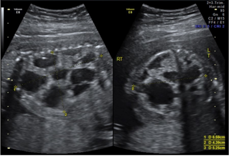 Congenital pulmonary airway malformation