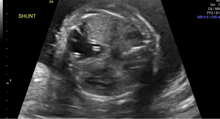 Congenital pulmonary airway malformation