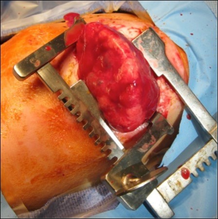 Congenital pulmonary airway malformation