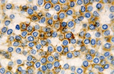 Journal of Clinical and Diagnostic Pathology-Leukaemia