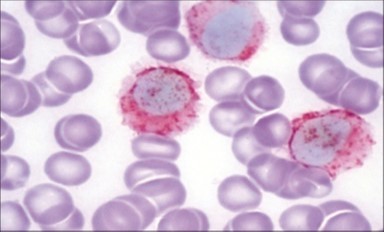 Journal of Clinical and Diagnostic Pathology-Leukaemia