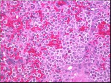 Journal of Clinical and Diagnostic Pathology-Leukaemia