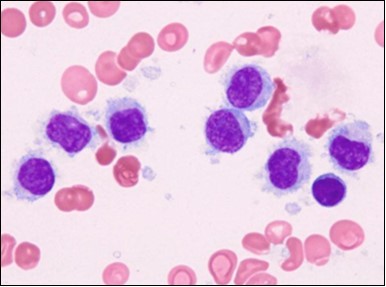 Journal of Clinical and Diagnostic Pathology-Leukaemia