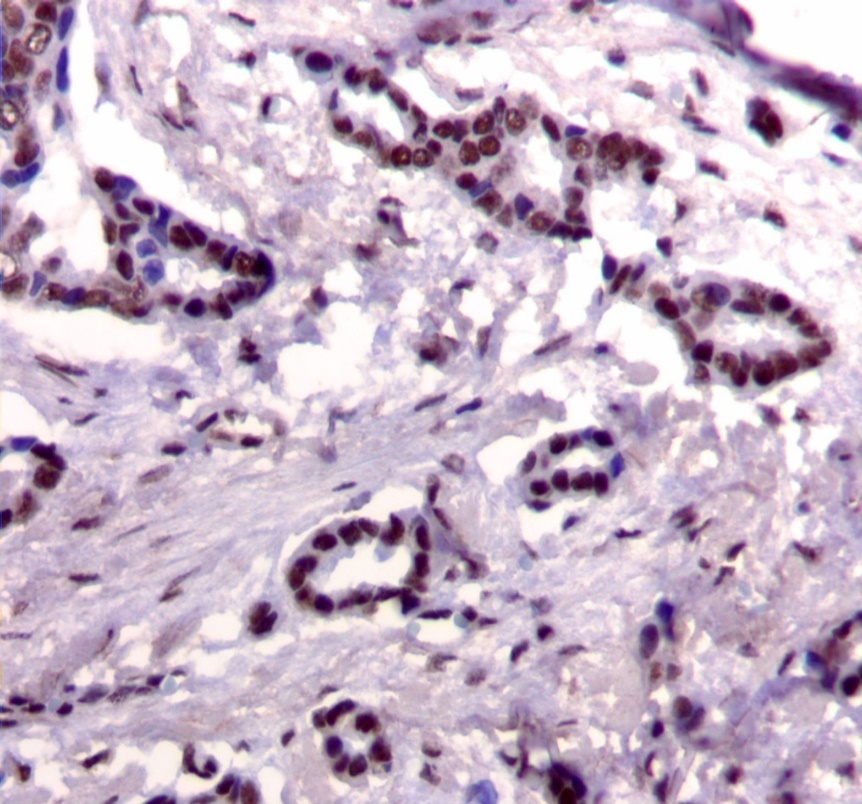 Journal Of Cancer Genetics And Biomarkers-breast cancer
