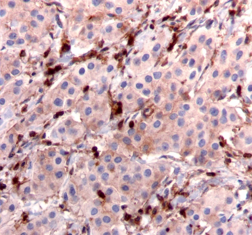 Journal Of Cancer Genetics And Biomarkers-breast cancer
