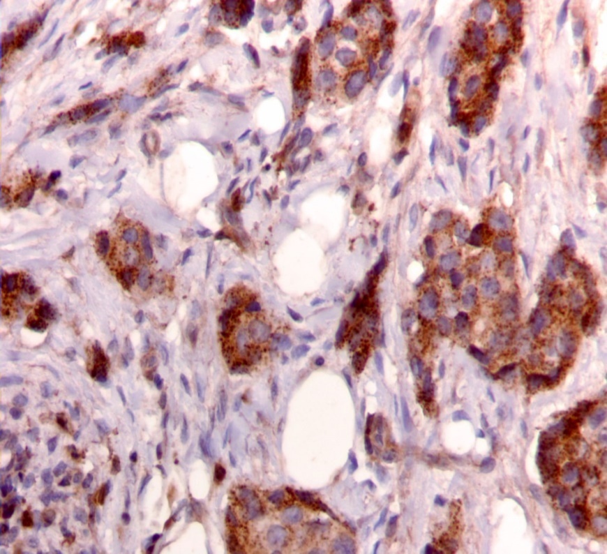 Journal Of Cancer Genetics And Biomarkers-breast cancer