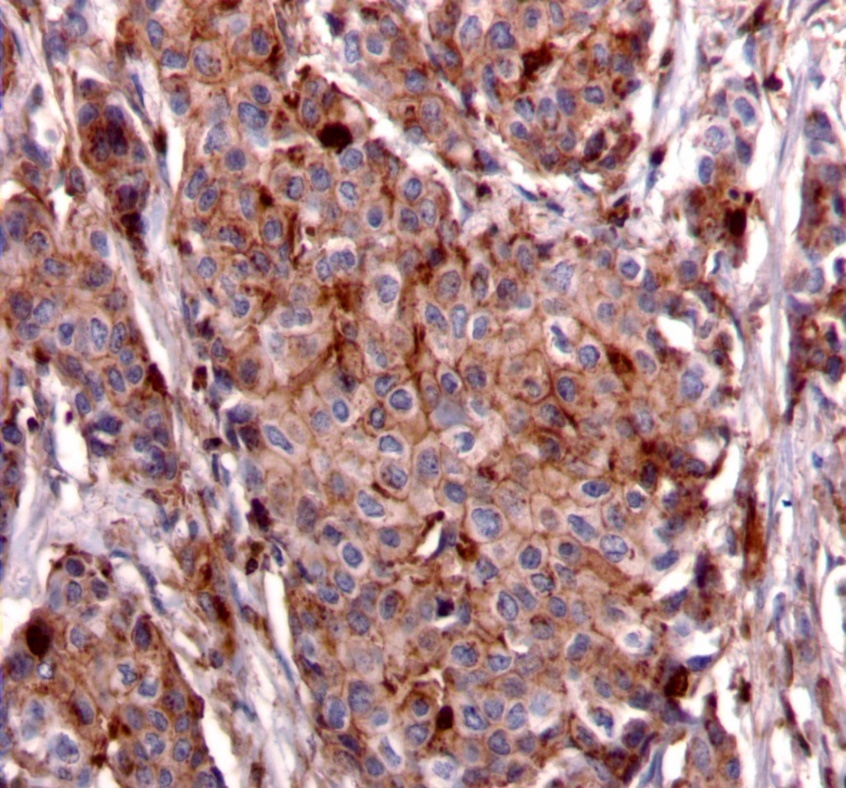 Journal Of Cancer Genetics And Biomarkers-breast cancer