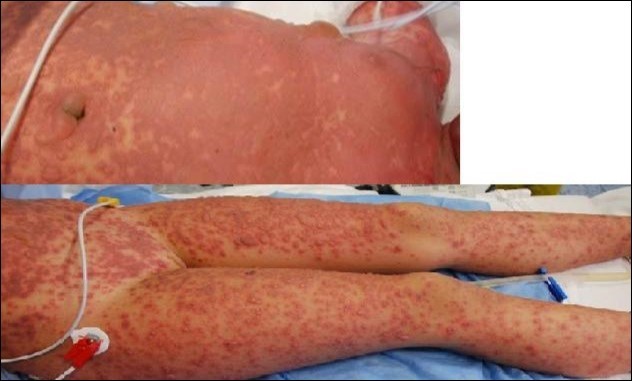 Toxic epidermal necrolysis