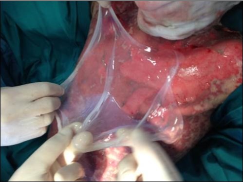Toxic epidermal necrolysis