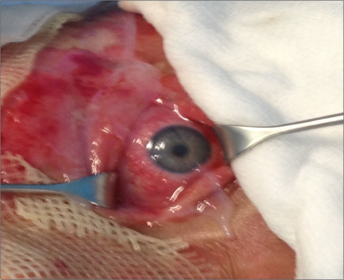 Toxic epidermal necrolysis