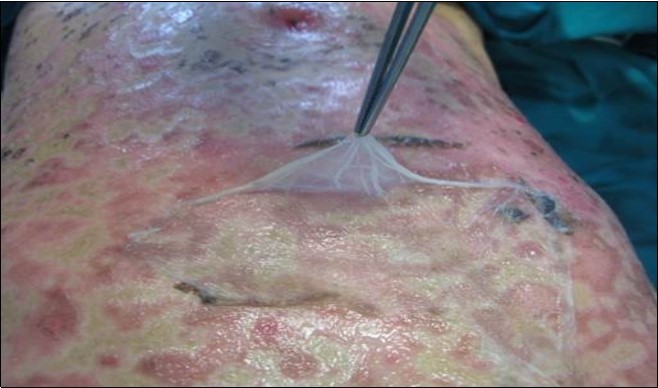 Toxic epidermal necrolysis