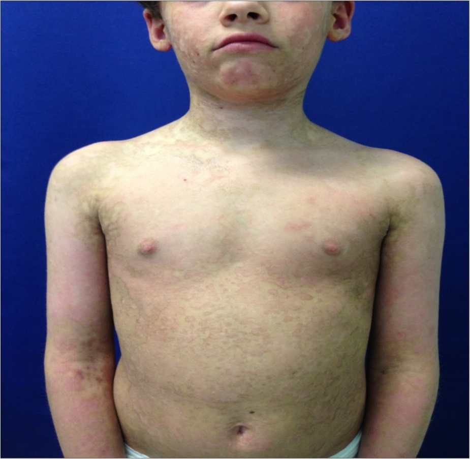 Toxic epidermal necrolysis