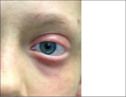 Toxic epidermal necrolysis