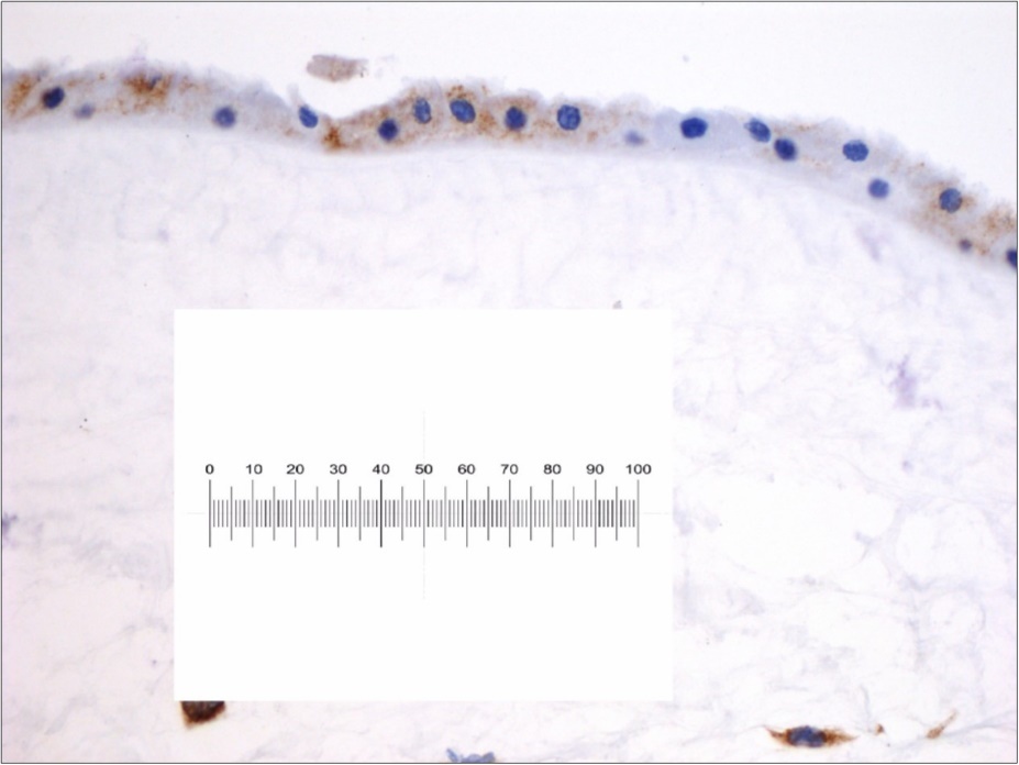Toxic epidermal necrolysis