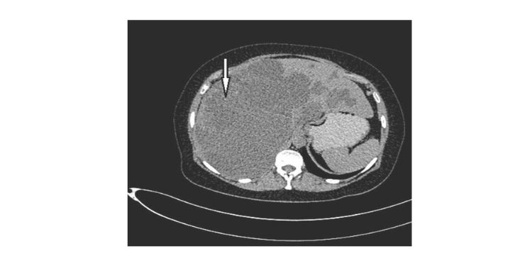 Article: Hepatic Cysts as a Manifestation of Polycystic Kidney Disease (Polycystic Liver Report of 2 Mother-Son Cases) 