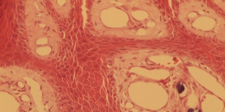 Article: Calcinosis Cutis on Vulgar Wart. Report of a Case