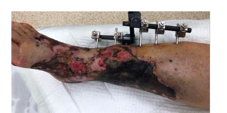 Article: Possibility to Influence Treatment of Open Tibial Fracture by Negative Pressure Wound Therapy