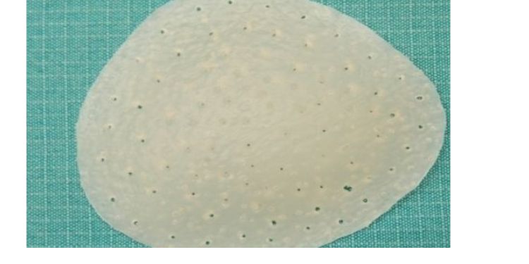 Article: Chest Wall Prostheses for Pectus Excavatum and Poland Syndrome Using 3D-Printed Models: Technique and Outcomes After 25 Years' Experience